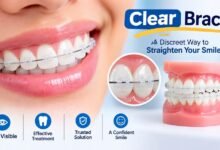 Clear Braces