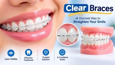 Clear Braces